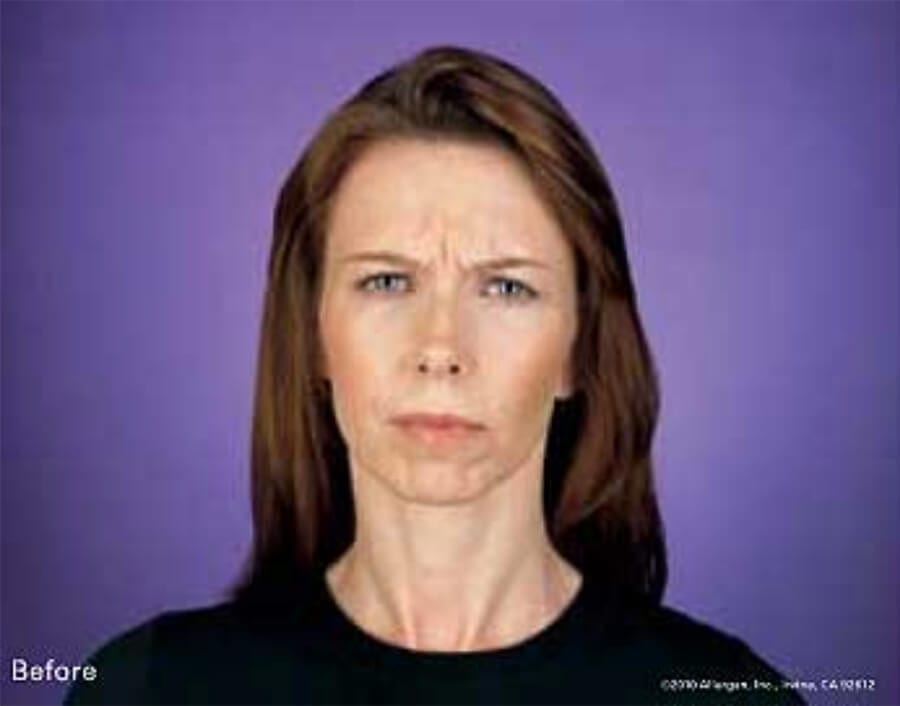 Botox patient before, furrowing brow.