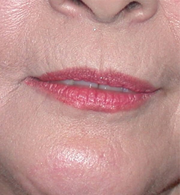 Fractional laser after image.