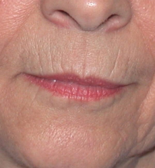 Fractional laser before image.