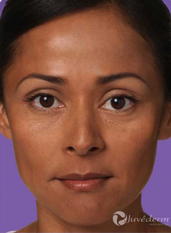 Juvederm after image.