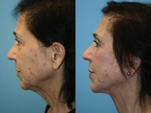 Before and After Image