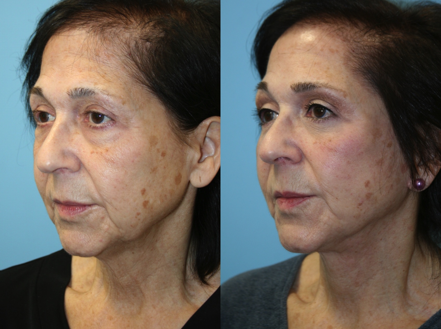 Before and After Image