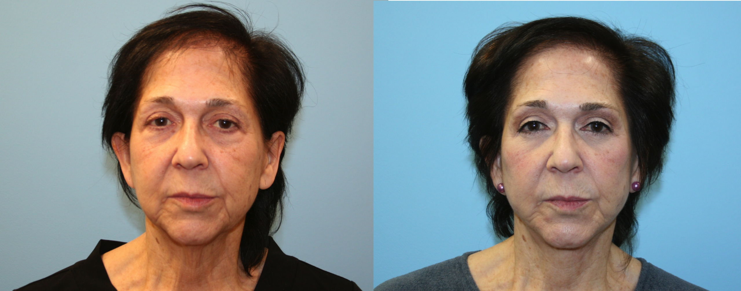 Before and After Image