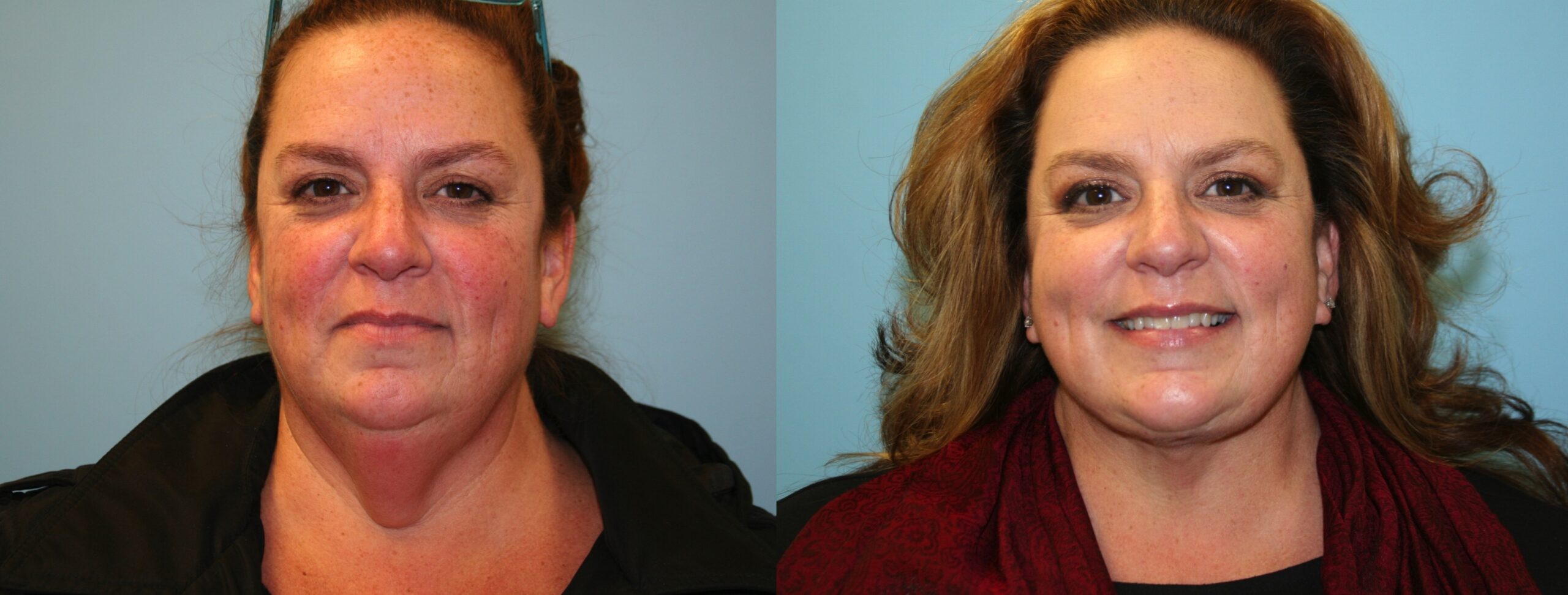 Before and After Image