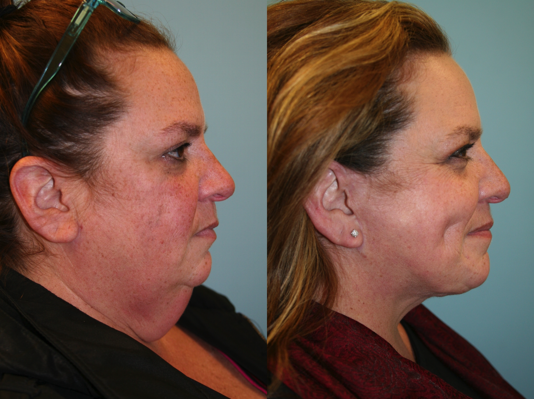 Before and After Image