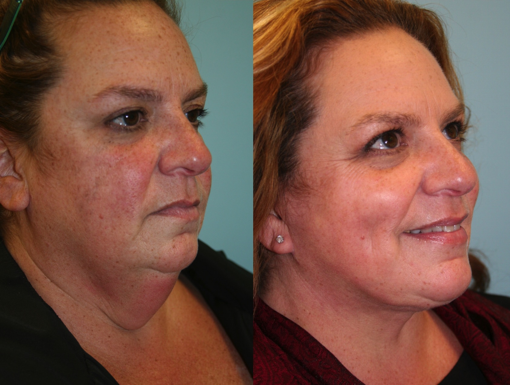 Before and After Image