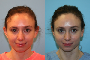 Before and After Image