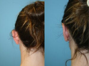 Before and After Image