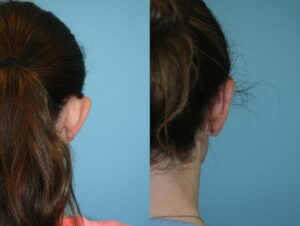 Before and After Image