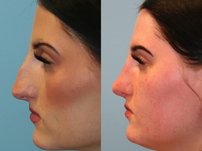 Before and After Image