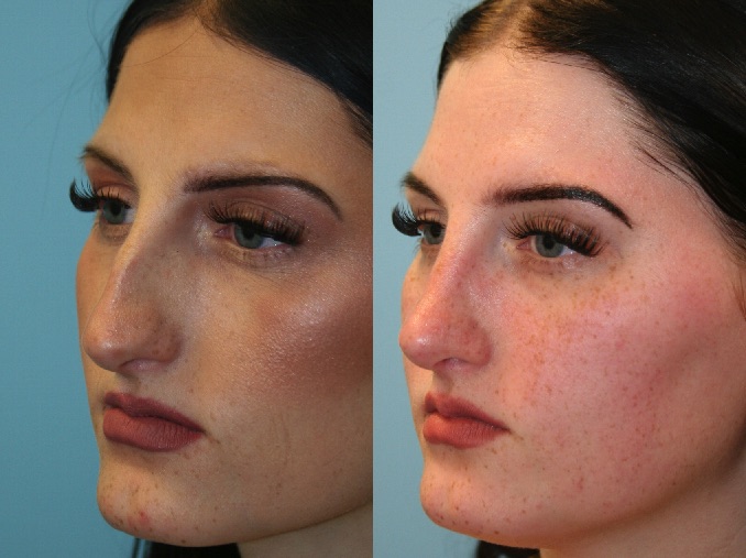 Before and After Image