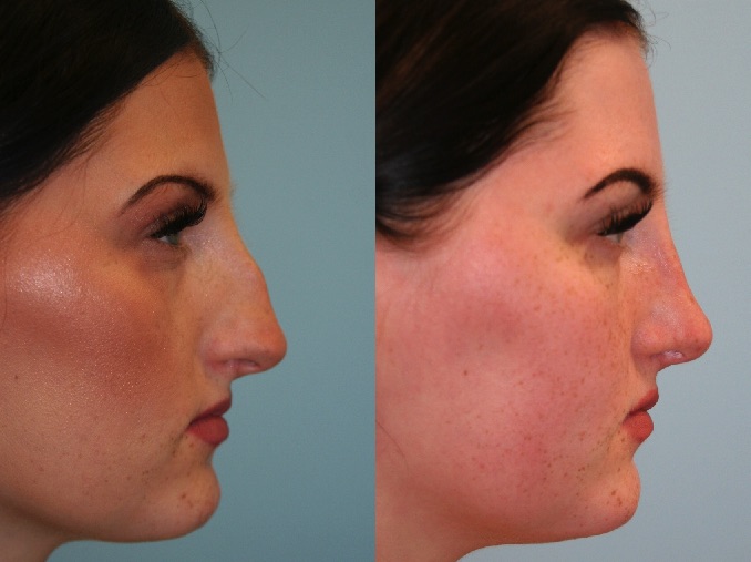 Before and After Image