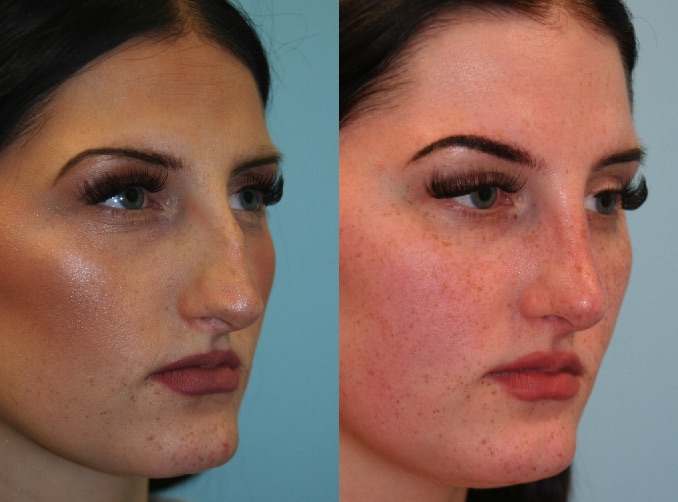 Before and After Image