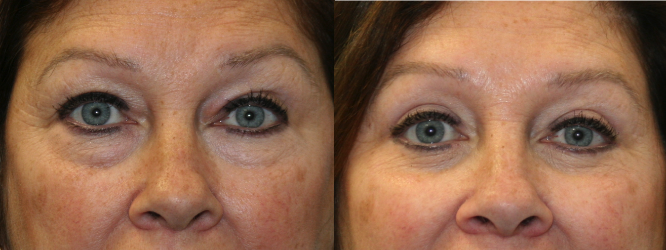 Before and After Image