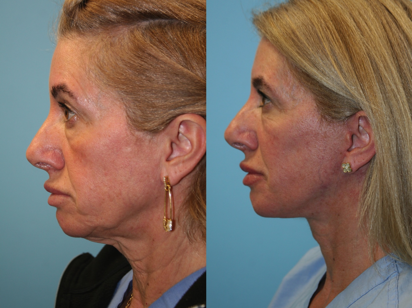 Before and After Image