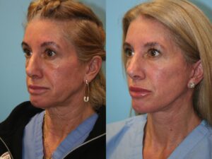 Before and After Image