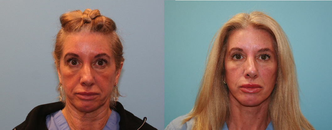 Before and After Image