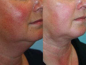 Before and After Image