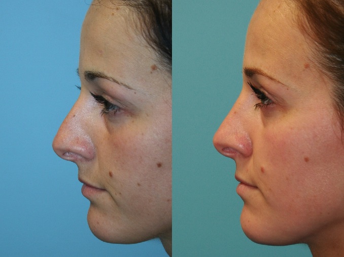 Before and After Image