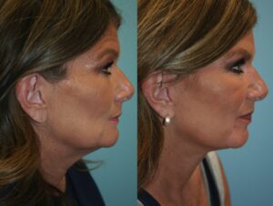 Before and After Image