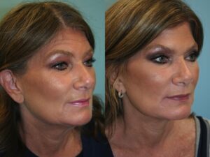 Before and After Image