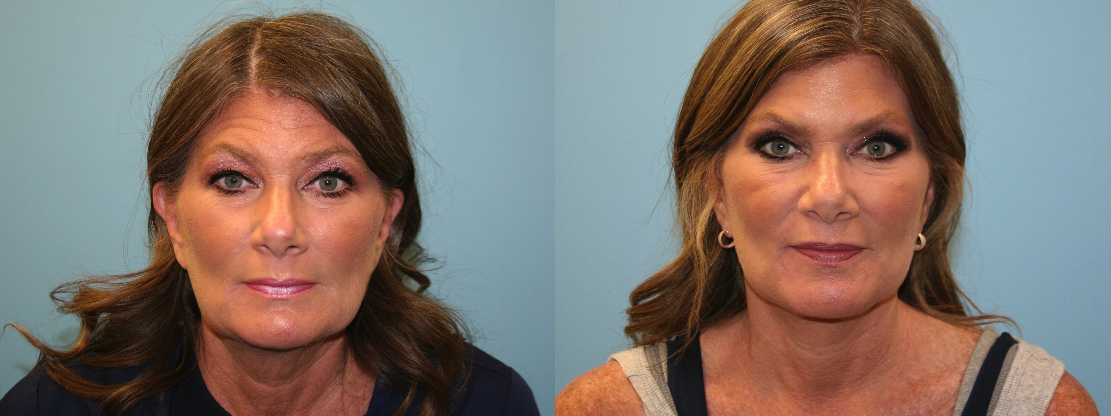 Before and After Image