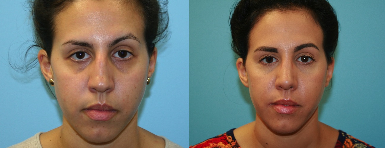 Before and After Image