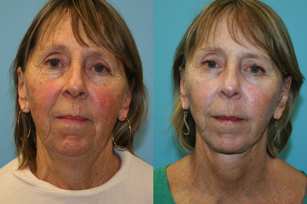 Before and After Image