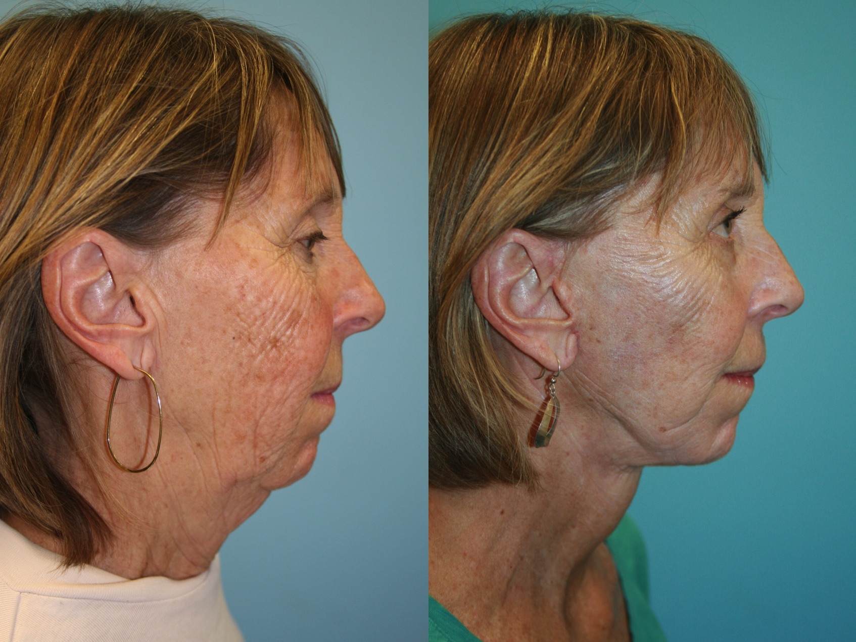 Before and After Image