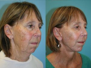 Before and After Image