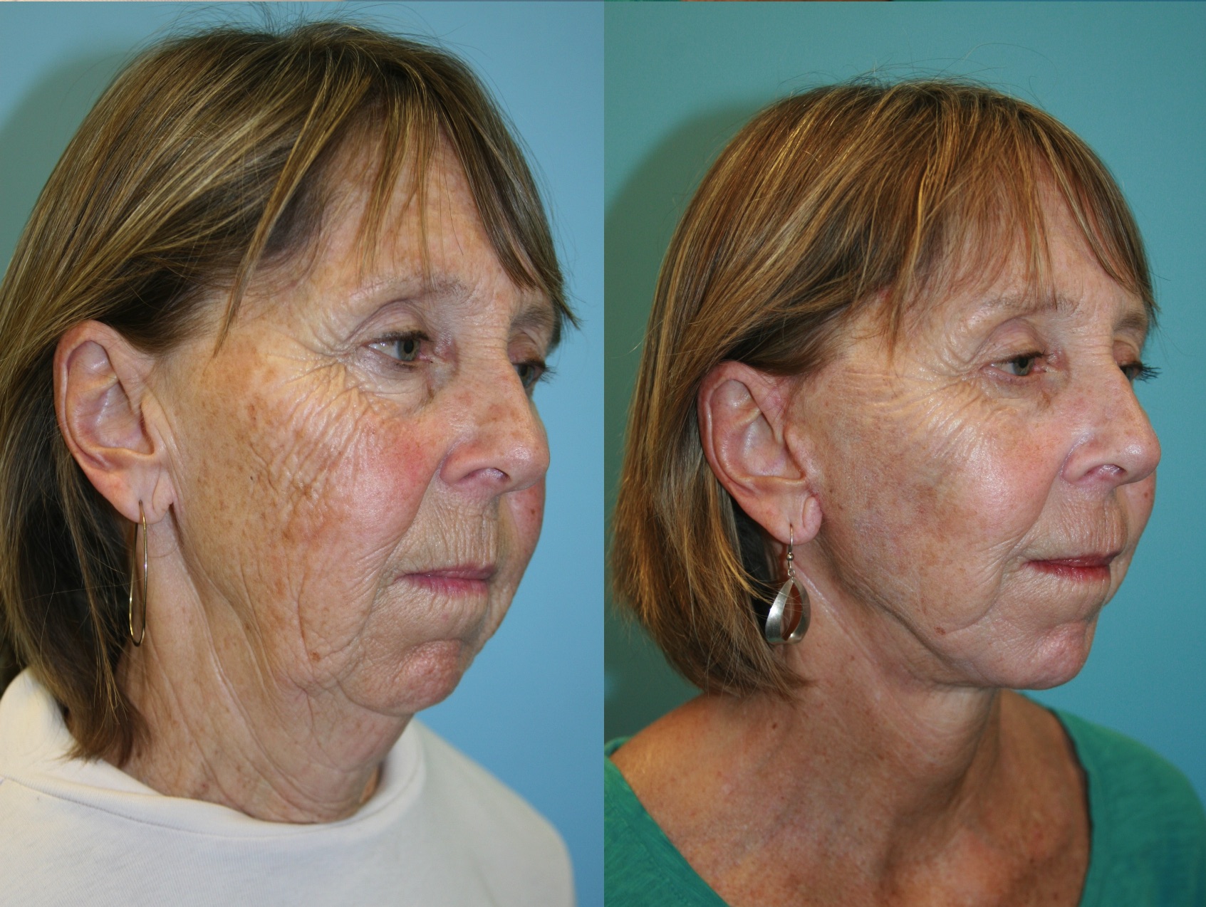 Before and After Image