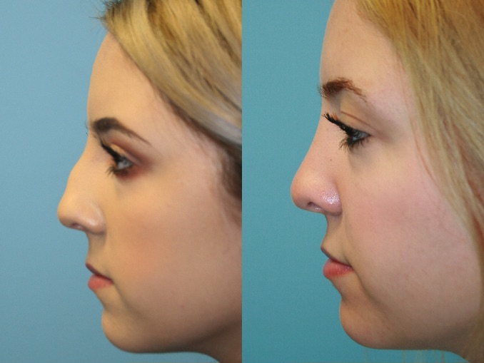 Before and After Image