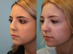 Before and After Image