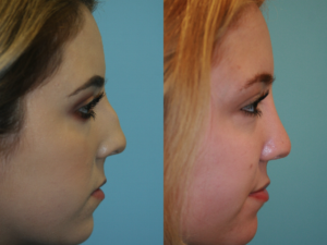 Before and After Image