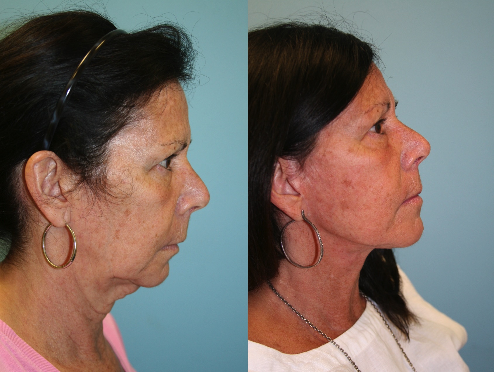 Before and After Image