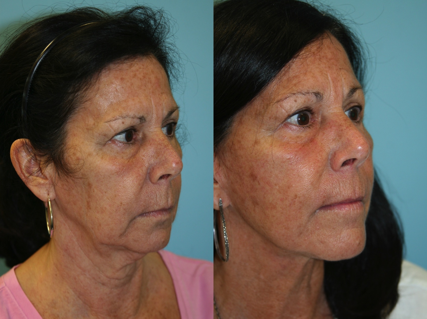 Before and After Image