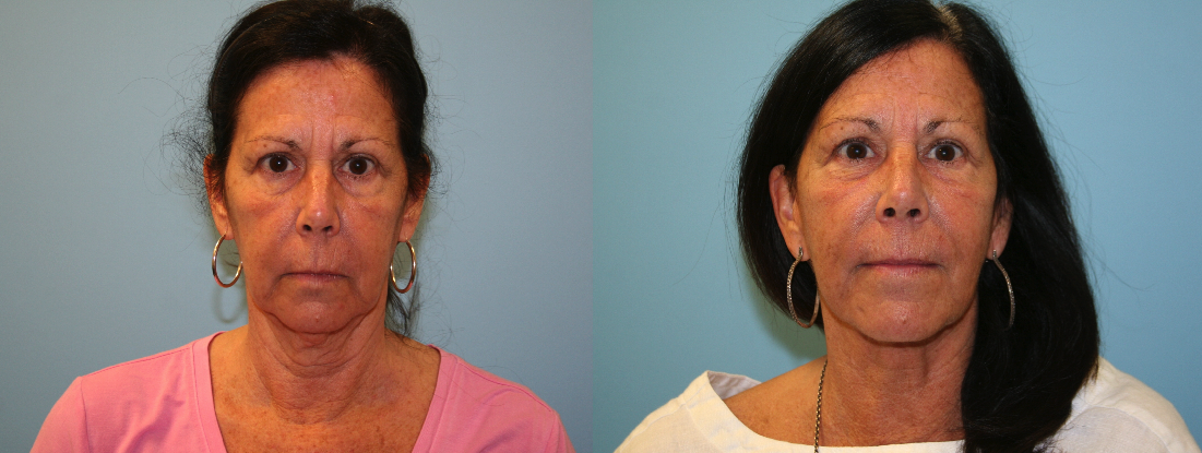 Before and After Image