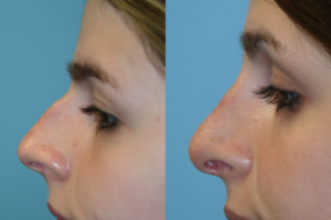 Before and After Image