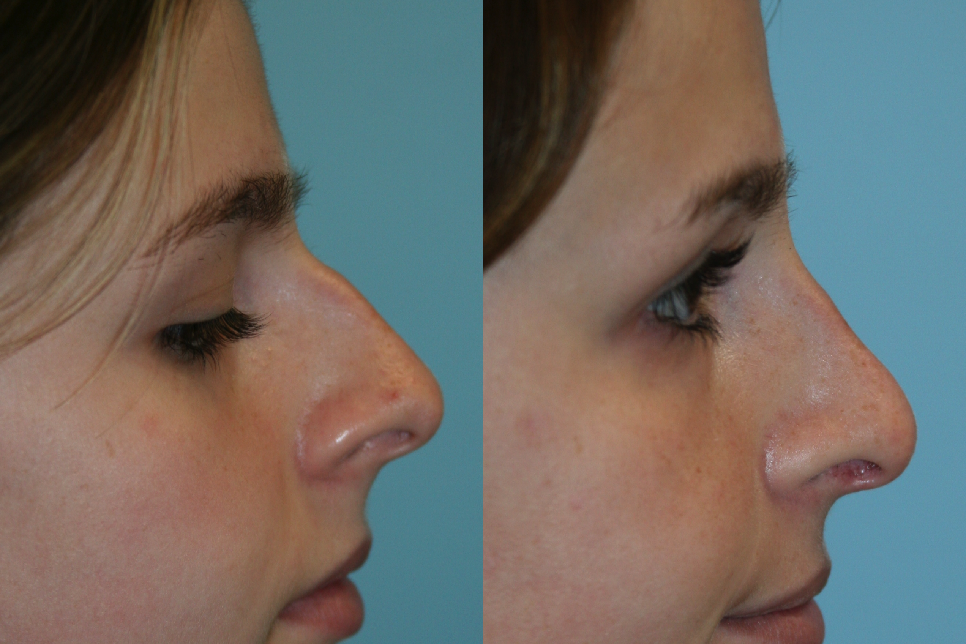 Before and After Image