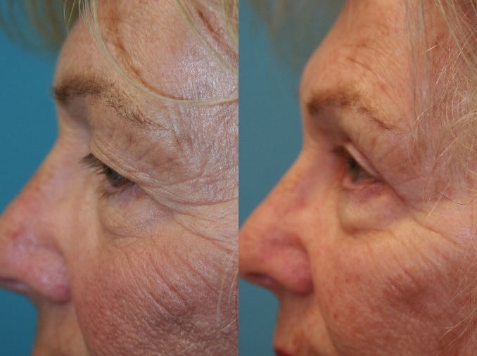 Before and After Image