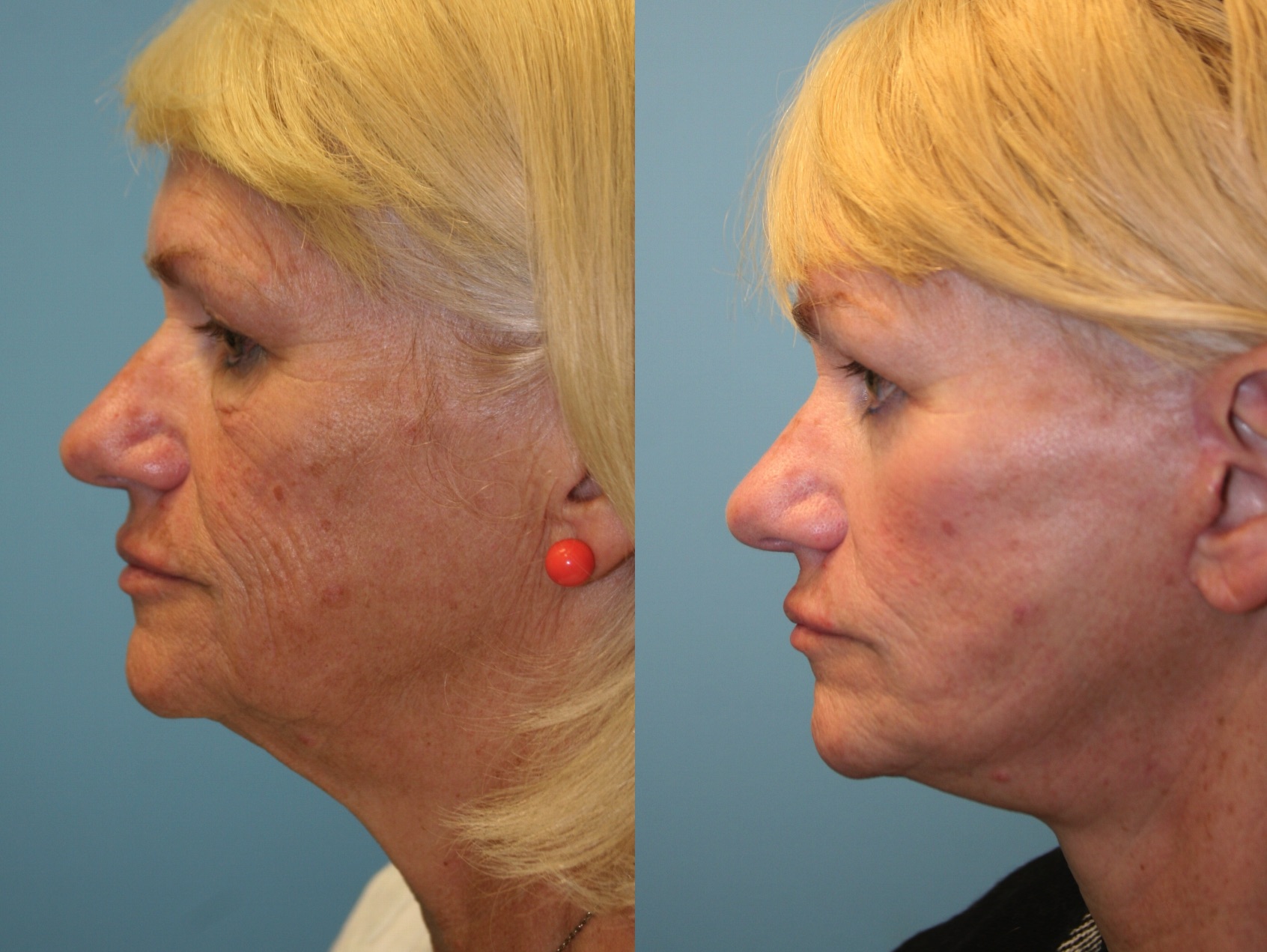 Before and After Image