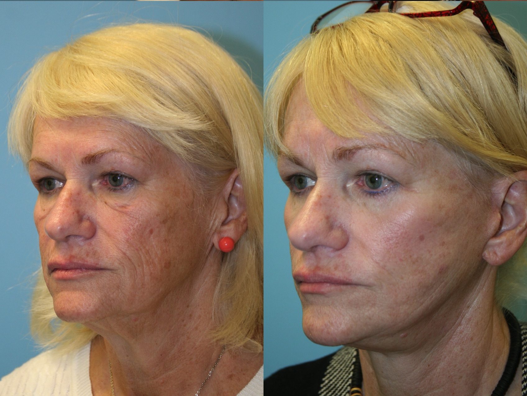 Before and After Image