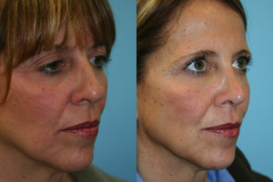 Before and After Image