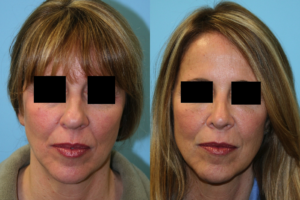 Before and After Image