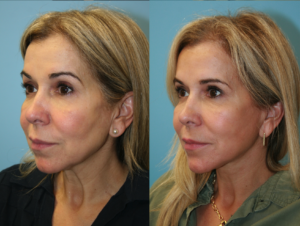 Before and After Image