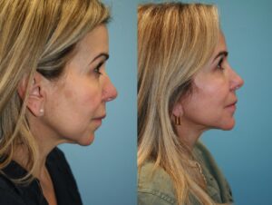 Before and After Image