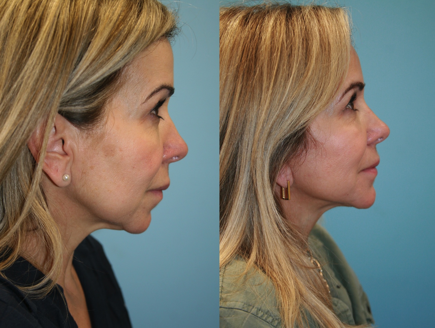 Before and After Image