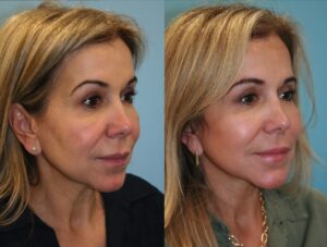 Before and After Image