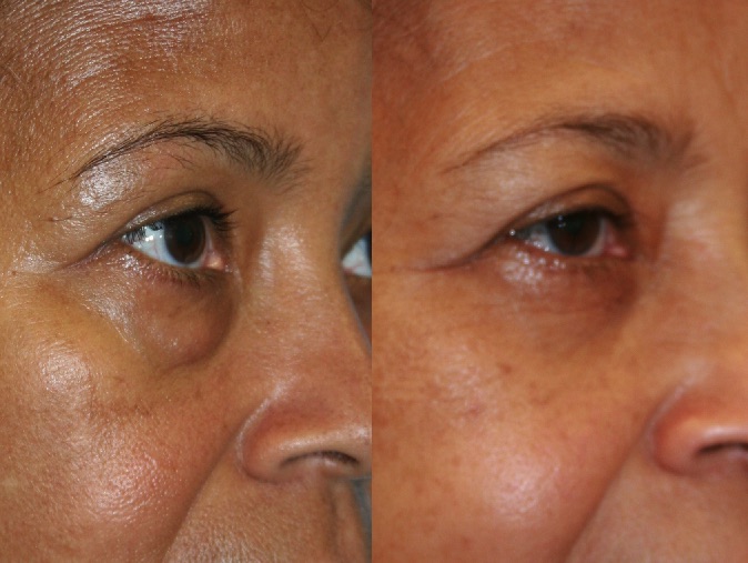 Before and After Image