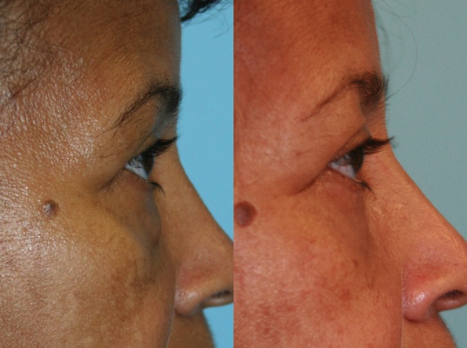 Before and After Image